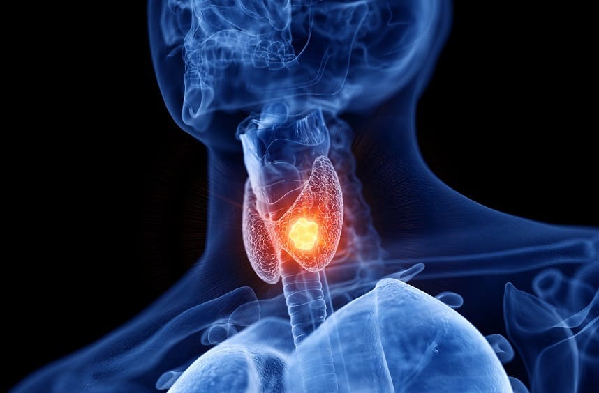 cirurgia de tireoide